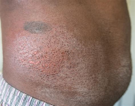 Contact Dermatitis — Black And Brown Skin