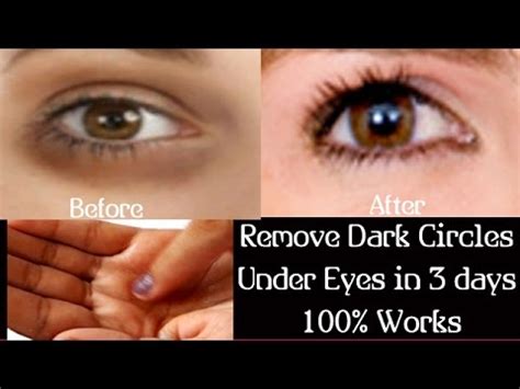 Place this warm cloth on your black eye and let it be there till it cools down. Remove Dark Circles Under Eyes at Home Simple Dark Circles ...
