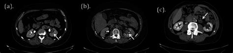 Ct and mri are used both for detection and characterization of neoplasms suspected to represent renal four of the 12 patients developed acute renal failure related to hepatorenal syndrome; Axial slices of excretory phase CT scan showing (a) UTUC ...