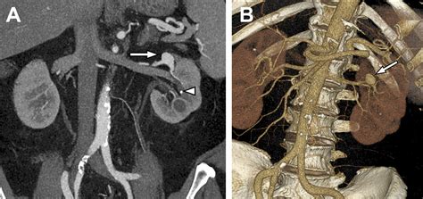 Ct Angiography Of The Renal Circulation Radiologic Clinics
