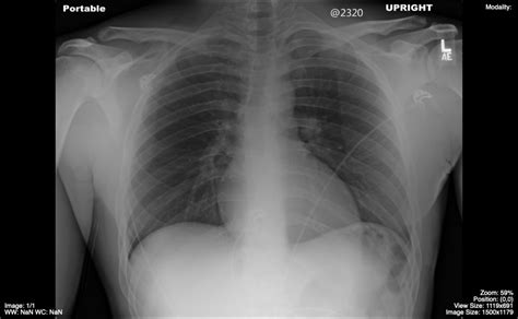 Approach To The Chest X Ray Cxr Undergraduate