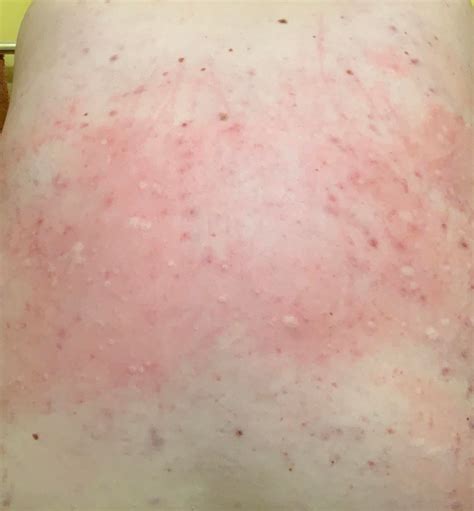Itchy Red Rash And White Bumps On My Sons Back Diagnoseme