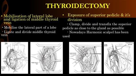 Thyroidectomy Operative Surgery