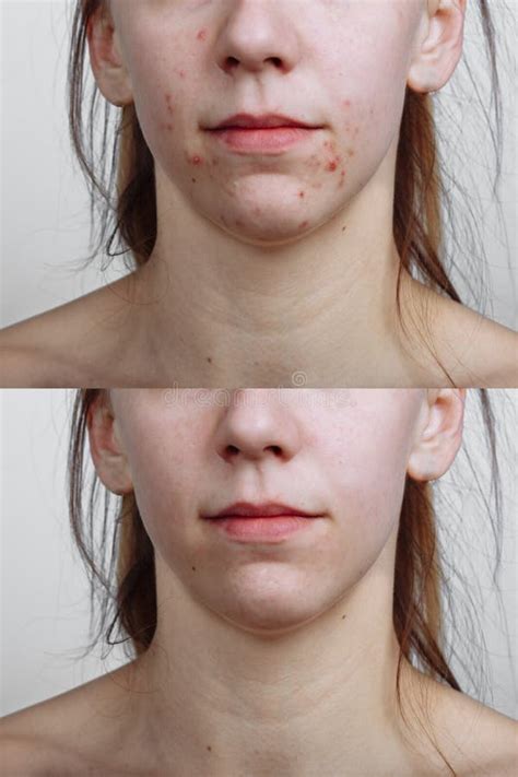 Young Woman Before And After Acne Treatment Closeup Skin Care Concept