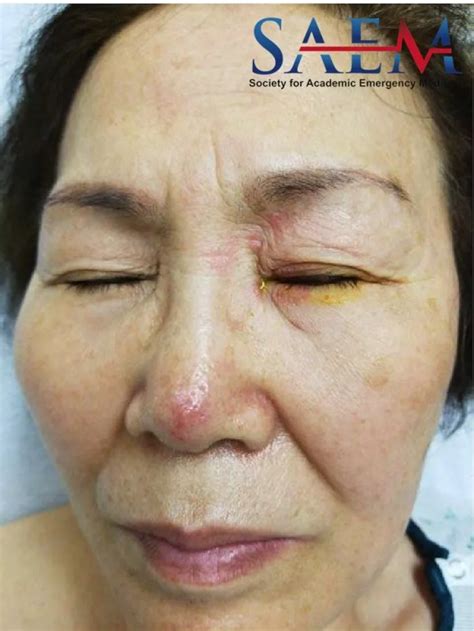 Saem Clinical Image Series A Case Of A Painful Facial Rash