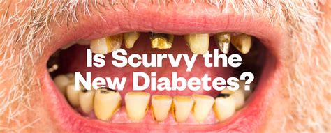 Is Scurvy The New Diabetes Its Horrible Deadly — And Insanely By