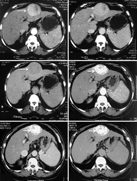 Role Of Computed Tomography In Prediction Of Tumor Necrosis Of