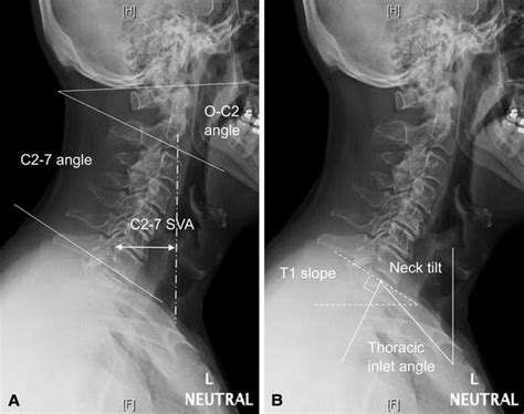 Correlation And Differences In Cervical Sagittal Alignment Parameters