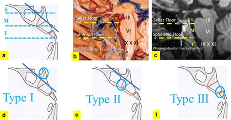 Types Of Chordoma Ac The Clivus Can Be Divided Into Superior Middle