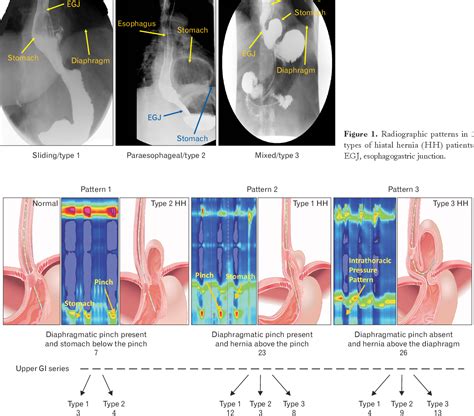 Figure 2 From Morphology Of The Esophageal Hiatus Is It Different In 3