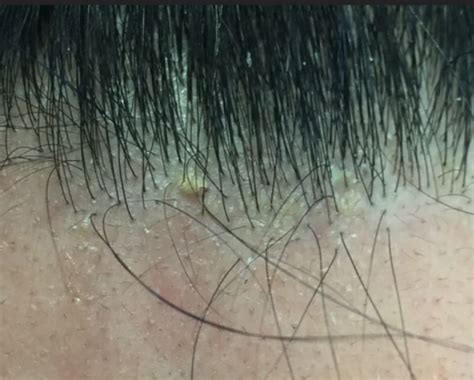 Seborrheic Dermatitis Of The Frontal Hairline — Donovan Hair Clinic