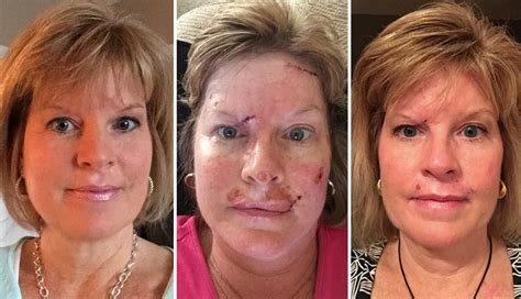 This Woman Shared Raw Photos Of Her Skin Cancer Recovery To Warn