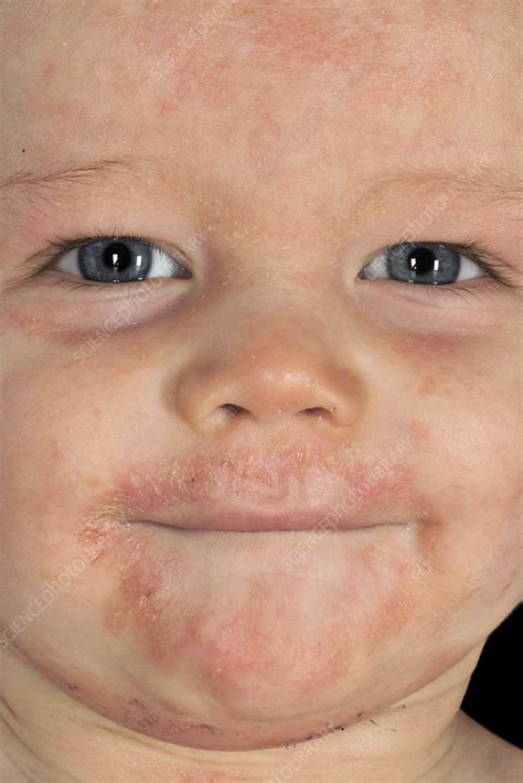 Atopic Eczema On A Babys Face Stock Image C0389472 Science