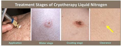 Cryotherapy Treatment In Plano Tx Skin Md And Beyond
