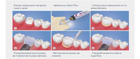 Cementos Dentales De Medicaline ¡conoce Sus Características Y Ventajas