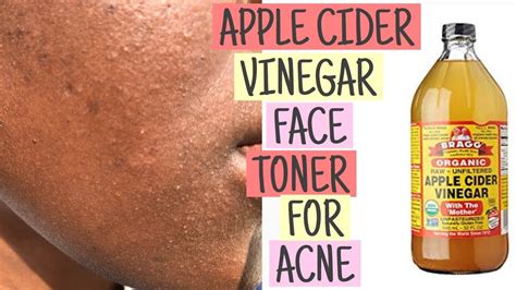 Diy Apple Cider Vinegar Home Made Face Toner For Acne And Textured