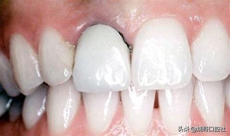 根管後戴牙套牙齦會發黑？醫生：不要選這種牙冠，遠離4個危害 每日頭條