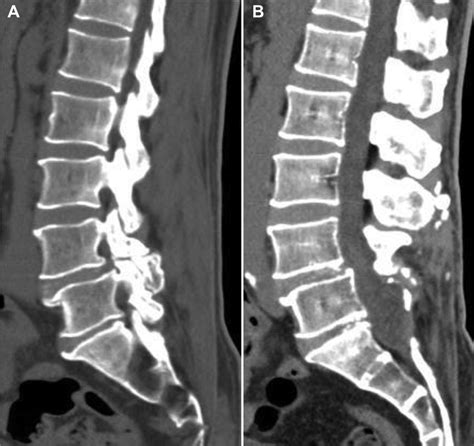 A Preoperative Computed Tomography Reveals A L4 Pars Fracture With