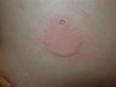 Red Circle On Skin Not Itchy Not Raised
