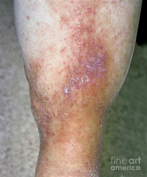 Varicose Eczema Photograph By Tony Craddockscience Photo Library Pixels