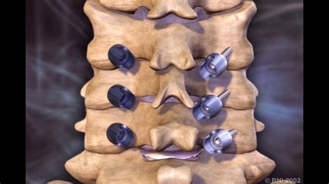 Cervical Lateral Mass Screws Youtube