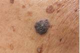 Pictures of What Doctor To See For Moles