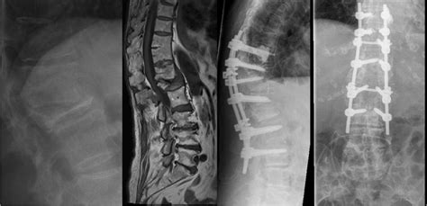L1 Compression Fracture In Severe Osteoporosis Led To Kyphosis And
