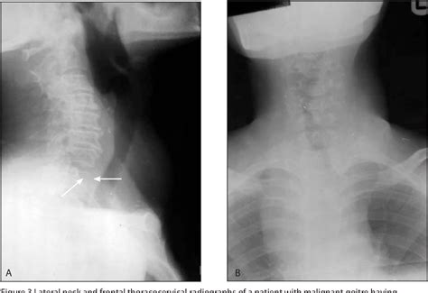 Thyroid Calcification On X Ray