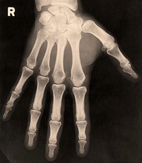 X Ray Of Right Hand Photograph By James Stevensonscience Photo Library