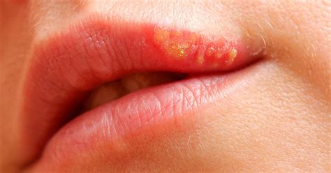 Herpes Labial Qu Causa Las Calenturas Labiales Tratamientos