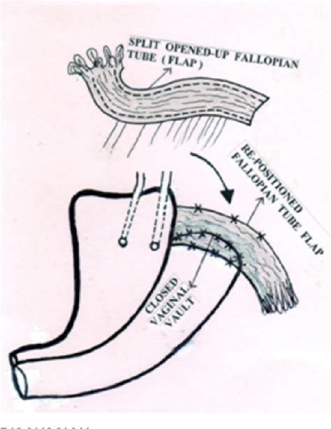 Figure 2 From Fallopian Tube Flaps Ftfs For Repairing High Vesico