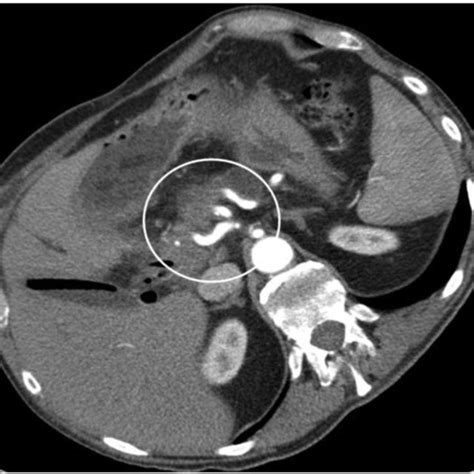 Ct Scan Showing Pancreatic Head Cancer With Infiltration Of The Portal