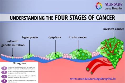 What Are The Four Stages Of Cancer Quora