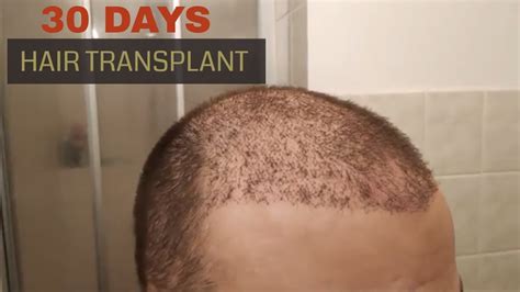 Hair Transplant Results 1 Month Post Op Youtube