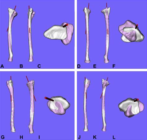 Figure 1 From Rotational Corrective Osteotomy For Malunited Distal