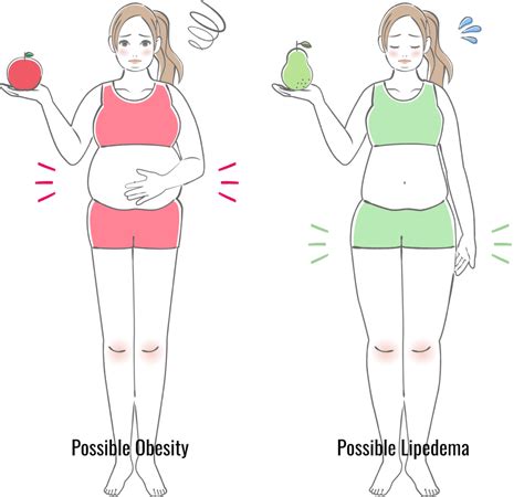 Lipedema Diagnosis Obesity And Bmi