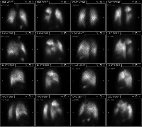 Part 4 Lung Radiology Key