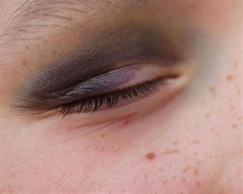 How To Get Rid Of A Black Eye Without Makeup Mugeek Vidalondon