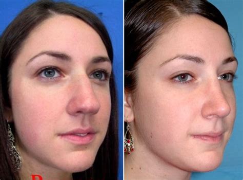 Nose Job Before And After Fat Nose Before And After