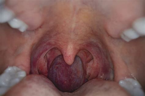 Hpv Throat Cancer Risk Factors Symptoms Treatment And More