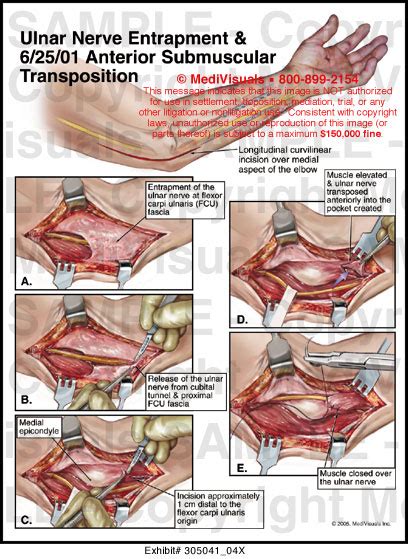 Ulnar Nerve Entrapment And Anterior Submuscular Transposition