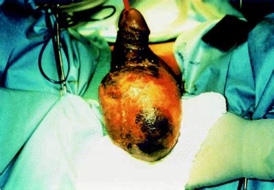 The term 'necrosis' refers or death of living cells in a localized region of the body. Far-advanced Fournier's gangrene of the scrotum (not the ...