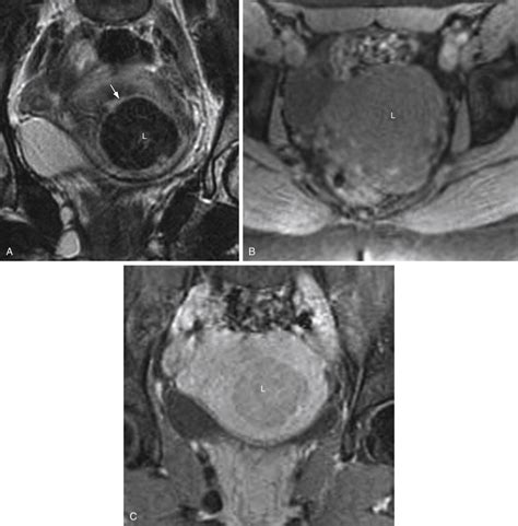 Uterine Leiomyomas Radiology Key