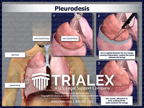 Pleurodesis Trialexhibits Inc