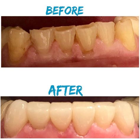 Smile Gallery Warren MI | Before & After Photos of Patients