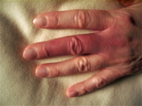 Es kann aber sowohl prädiktor als auch symptom bei zugrunde liegenden erkrankungen unterschiedlichster pathogenese sein. Morbus Raynaud oder Raynaud-Syndrom: Hintergrund, Symptome ...