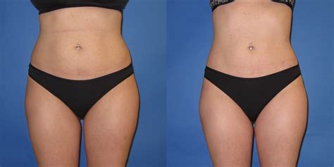 Liposculpture Before And After Core Plastic Surgery