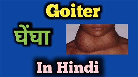Goiter In Hindi Youtube