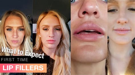 my first time getting lip fillers before and after 1 syringe juvederm ultra youtube