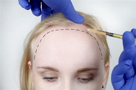 Haartransplantation F R Frauen Bio Hair Clinic